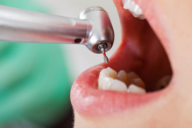Best Lost Filling or Crown Replacement in Evendale, OH